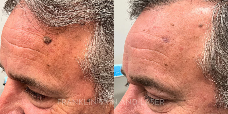 Mole Removal Before & After Image