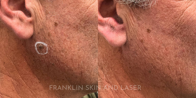 Mole Removal Before & After Image