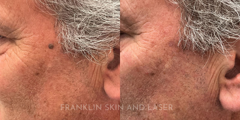 Mole Removal Before & After Image