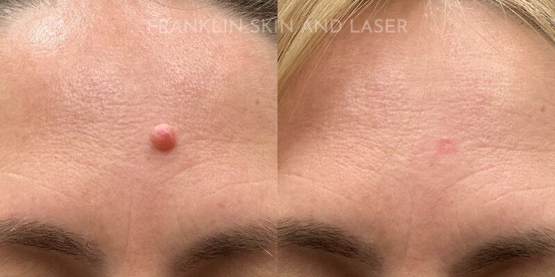 Mole Removal Before & After Image