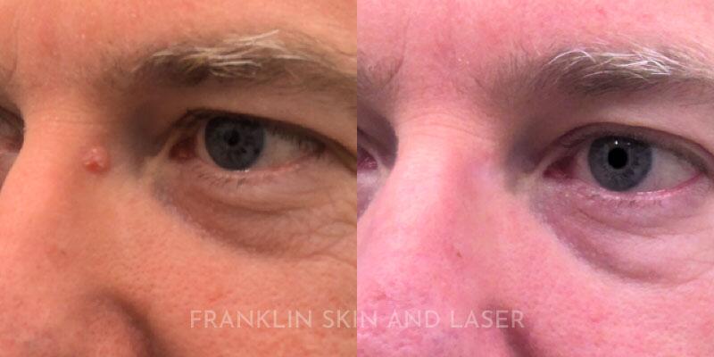 Skin Cancer Removal Before & After Image