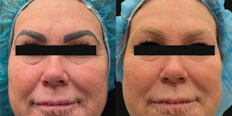 Brow Tattoo Removal Before & After Image