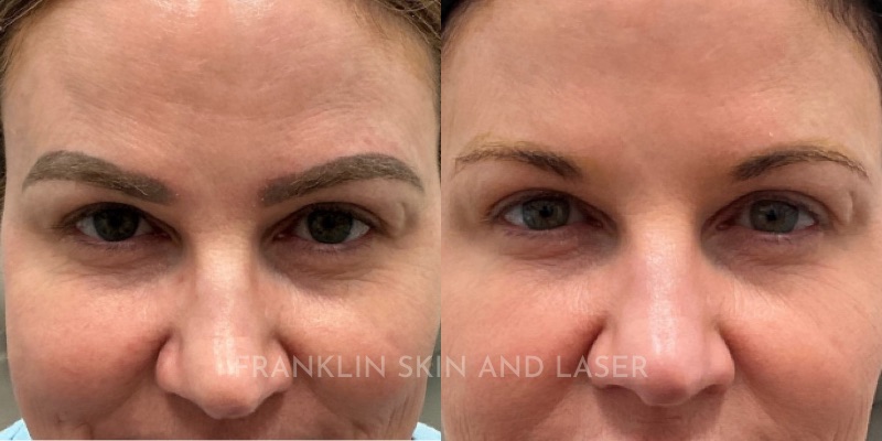 Brow Tattoo Removal Before & After Image