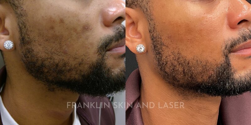 Clear Brilliant Before & After Image