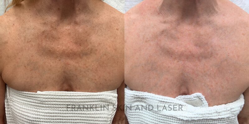 Clear Brilliant Before & After Image