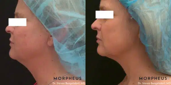 Morpheus8 Before & After Image