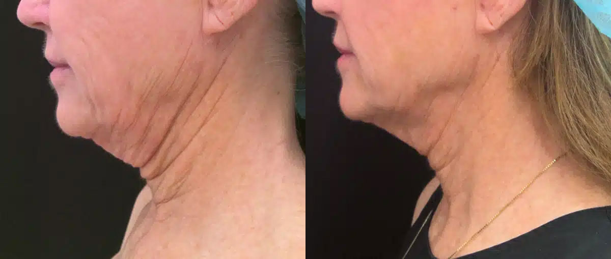 Thread Lift Before & After Image