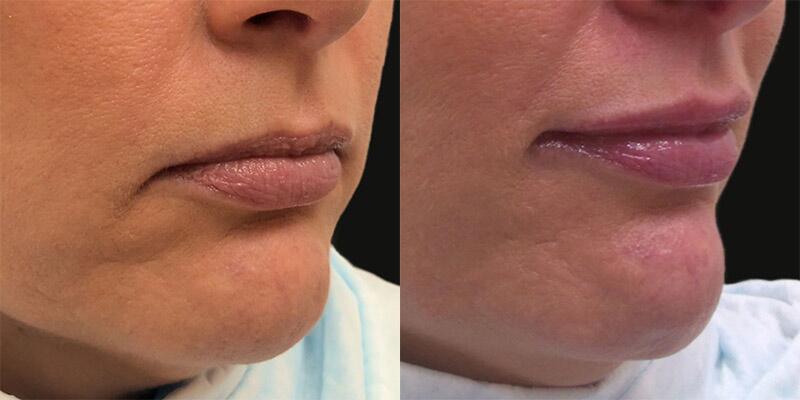 Filler Before & After Image