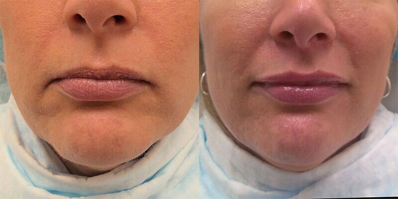 Filler Before & After Image