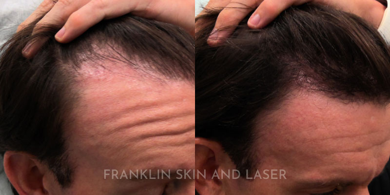 Hair Restoration Before & After Image