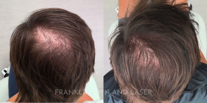 Hair Restoration Before & After Image