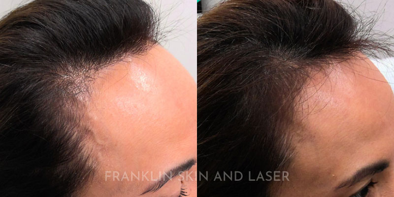 Hair Restoration Before & After Image