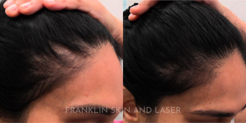 Hair Restoration Before & After Image