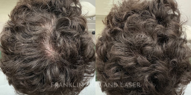 Hair Restoration Before & After Image