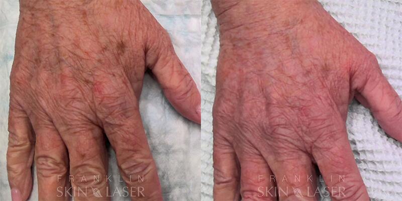 Hand Filler Before & After Image