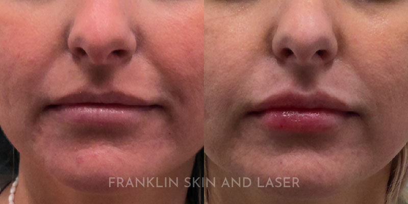 Lip Filler Before & After Image