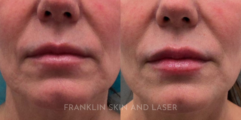 Lip Filler Before & After Image