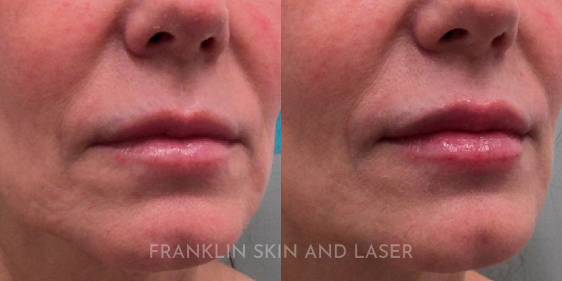 Lip Filler Before & After Image