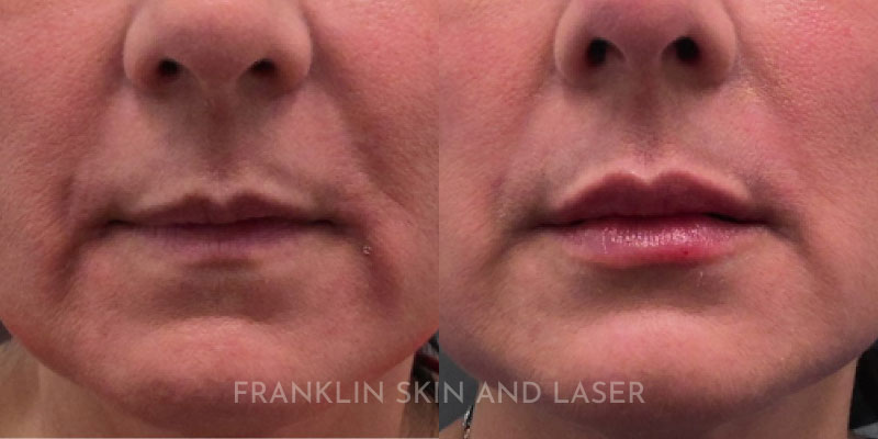 Lip Filler Before & After Image