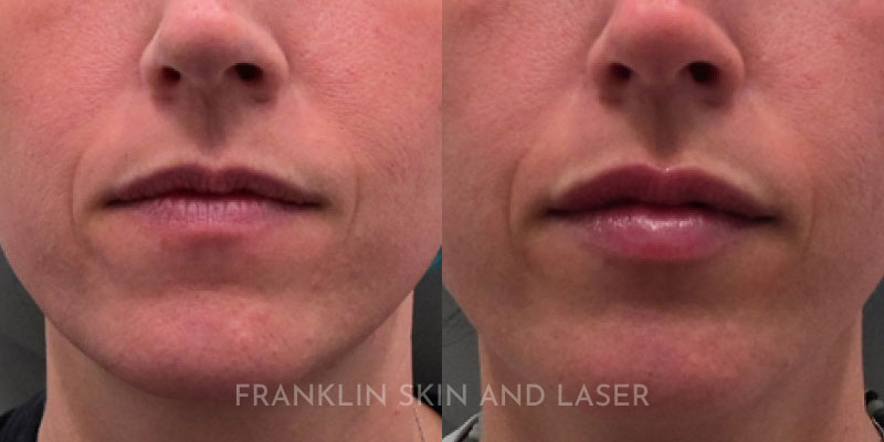 Lip Filler Before & After Image