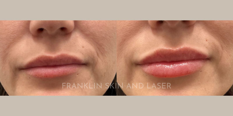 Lip Filler Before & After Image