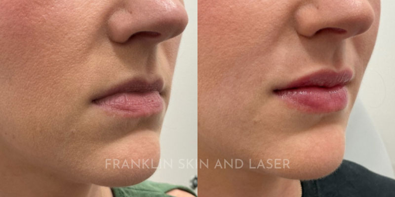 Lip Filler Before & After Image