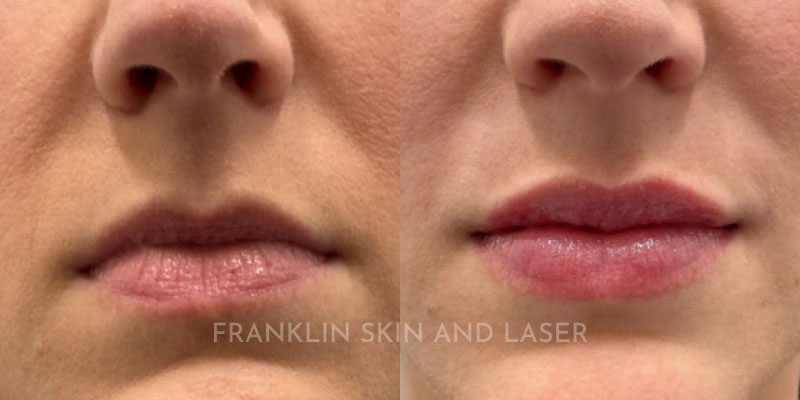 Lip Filler Before & After Image