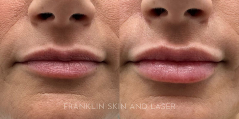 Lip Filler Before & After Image