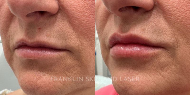 Lip Filler Before & After Image