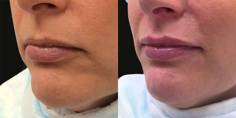 Lip Filler Before & After Image