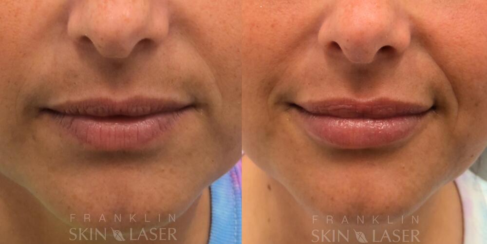 Lip Filler Before & After Image