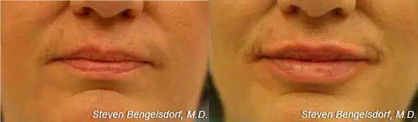 Lip Filler Before & After Image