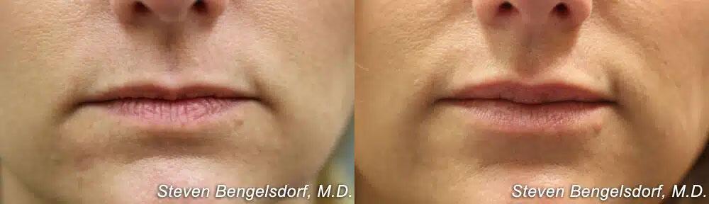 Lip Filler Before & After Image