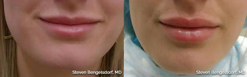 Lip Filler Before & After Image