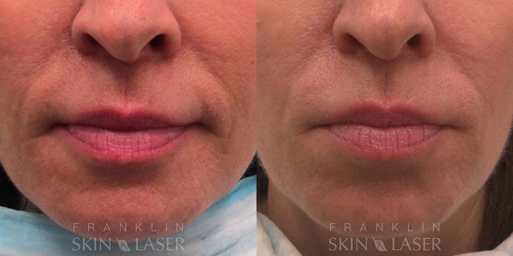 Lip Filler Before & After Image