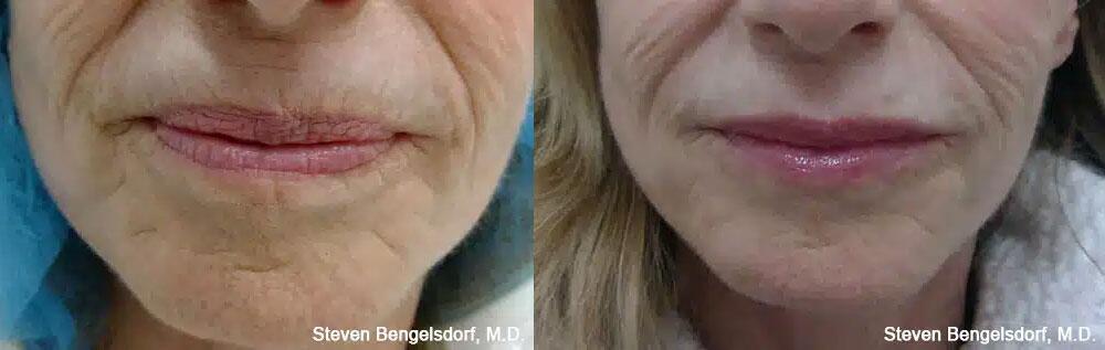 Lip Filler Before & After Image