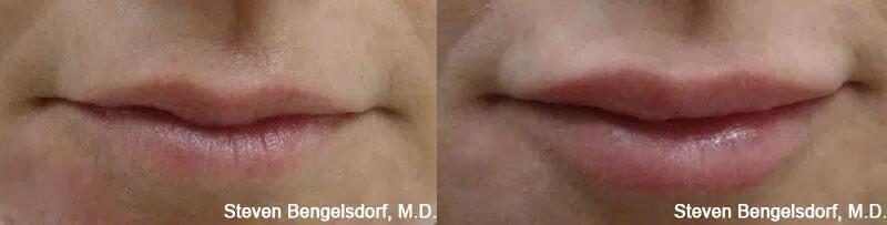 Lip Filler Before & After Image