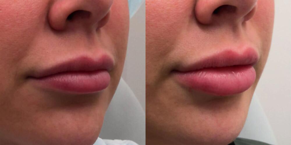 Lip Filler Before & After Image