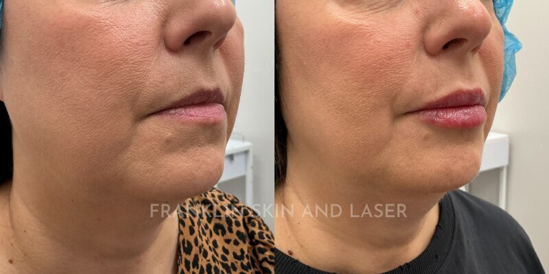 Lip Filler Before & After Image