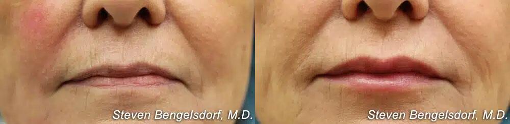 Lower Face Filler Before & After Image