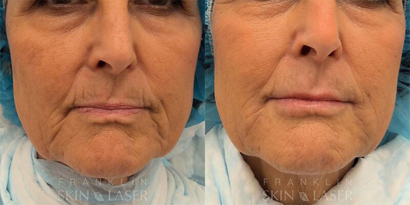 Lower Face Filler Before & After Image