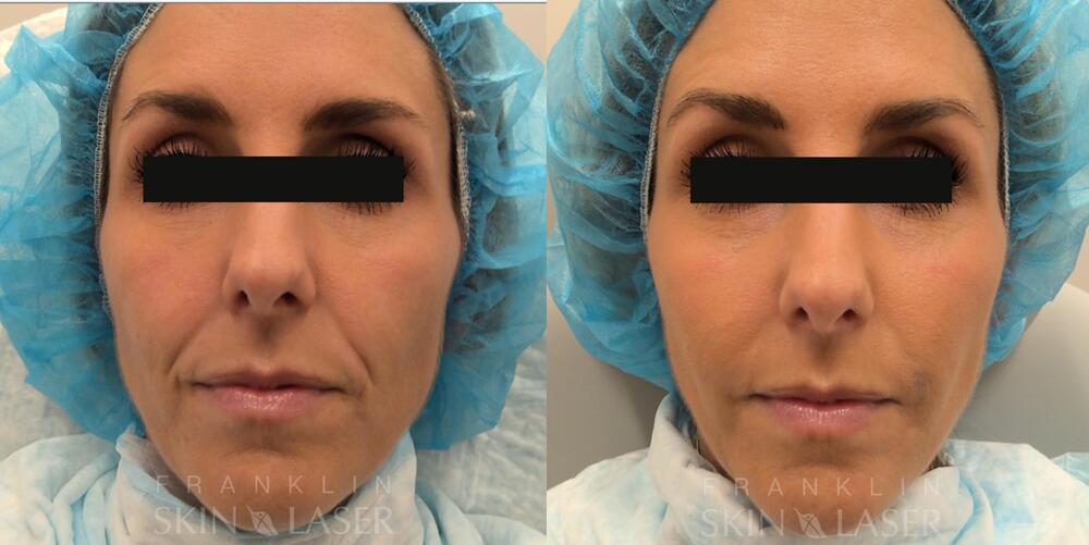 Mid Face Filler Before & After Image