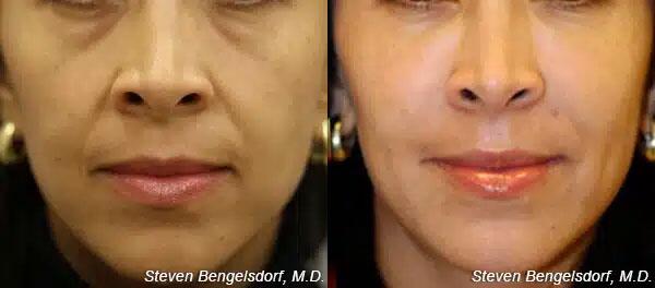 Mid Face Filler Before & After Image