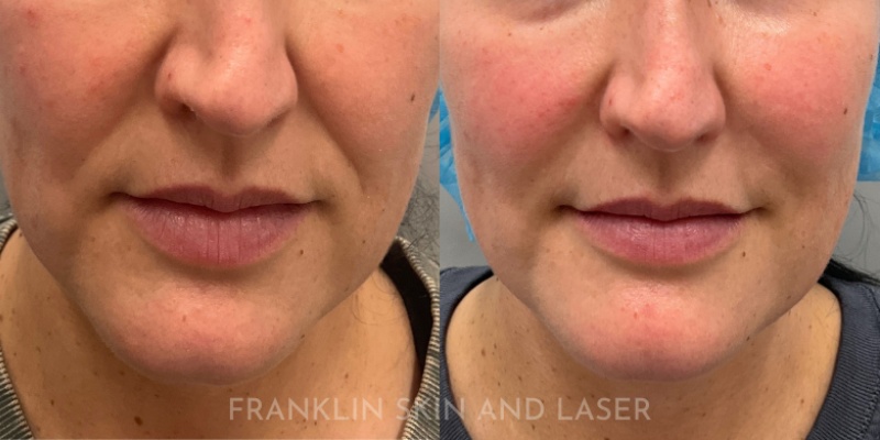 Mid Face Filler Before & After Image