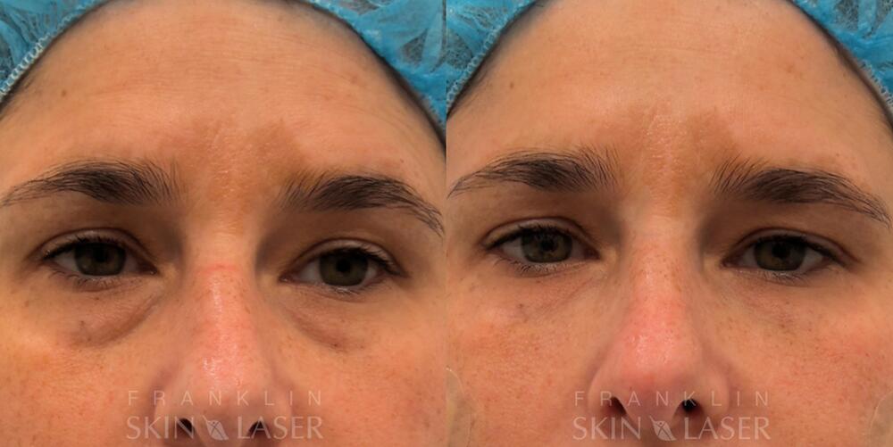 Undereye Fillers Before & After Image