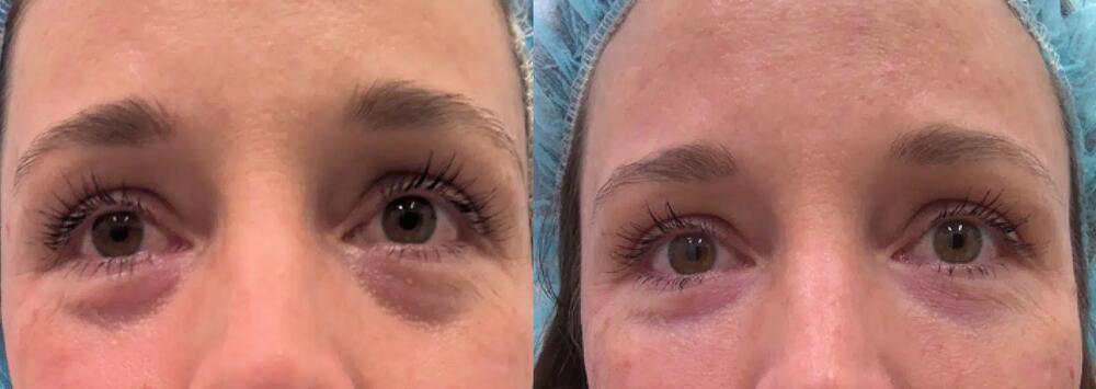 Undereye Fillers Before & After Image