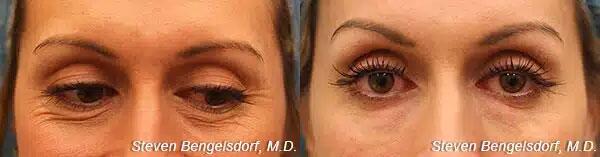 Undereye Fillers Before & After Image