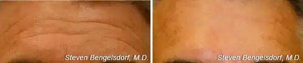 Upper Face Filler Before & After Image