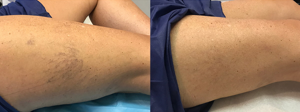 Laser Vein Reduction Before & After Image
