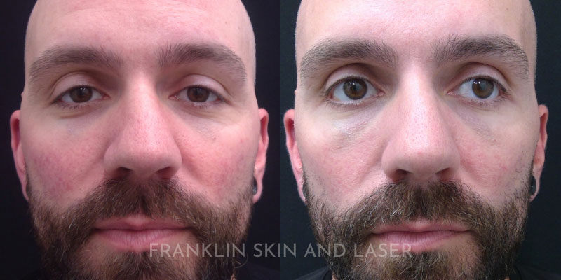 Photorejuvenation Before & After Image